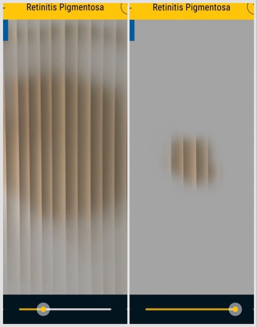 Capture d'écran avec des étapes tôt et tard de la vue avec la rétinite pigmentaire. À gauche, tôt, les bords de la vue sont flous avec des taches gris. À droite, tard, la vue est très réduite, et il n'y a qu'un point au centre où on peut voir vraiment. 